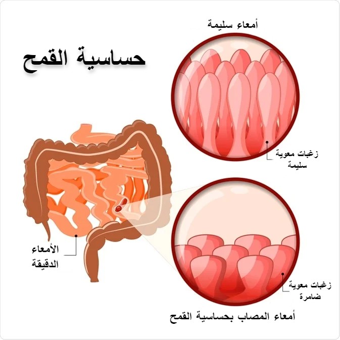 التعامل مع حساسية القمح